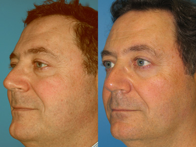 Facial Thermage / Rejuvenation  Boston - Massachusetts Facial Rejuvenation Doctor Dr. LoVerme in Wellesley, MA
