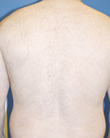 Permanent Hair Removal Boston - Massachusetts Plastic / Cosmetic Surgeon Dr. LoVerme in Wellesley, MA