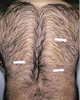 Permanent Hair Removal Boston Before and After - Massachusetts Plastic / Cosmetic Surgeon Dr. LoVerme in Wellesley, MA
